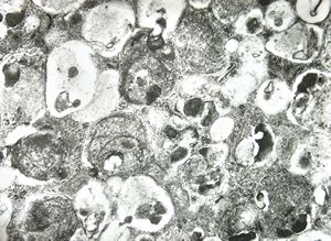F,1y. | epulis congenitalis (granulomatosa) F,1y. | epulis congenitalis (granulomatosa)